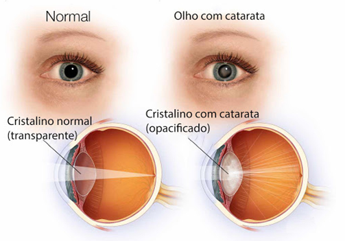 imagem Ilustrativa de Catarata
